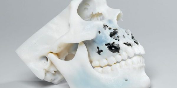 3D Printed Skull created by Medical Designers